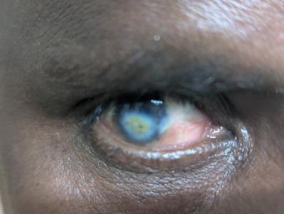 Corneal opacity_0001