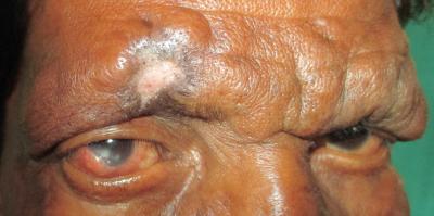 250318_Scleritis