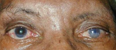 250406_ lagophthalmos with corneal scar
