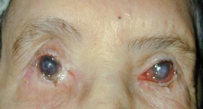 250406_corneal ulcer blind eyes