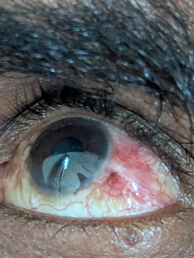 Photo 2. Episcleritis