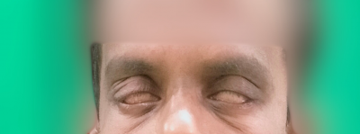 250421_Lagophthalmos 2