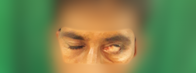 Lagophthalmos with Bell's phenomenon