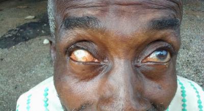 Corneal Scar