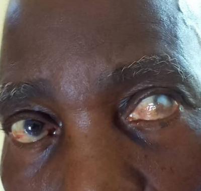 Corneal Scar