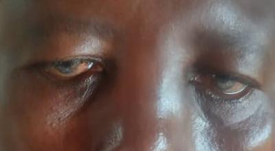 Lagophthalmos with Ectropion and exposure keratitis