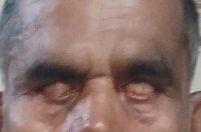 Lagophthalmos with ectropion and Bell's phenomenon