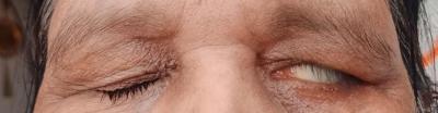 Lagophthalmos with Bell’s phenomenon