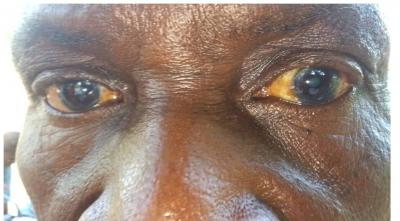 Cataract-other (age related, diabetes, trauma etc.)