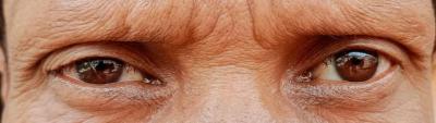 Superciliary madarosis (eyebrows)