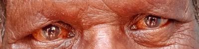 Blepharocalasis; Superciliary madarosis (eyebrows); Ciliary madarosis (eyelashes)