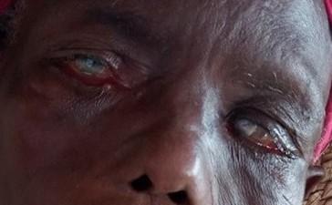 Lagophthalmos with exposure keratitis, Nigeria
