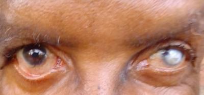 Right eye: lagophthalmos with ectropion; Left eye: Corneal scar