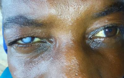 Corneal Scar