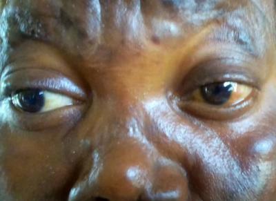Superciliary madarosis (eyebrows)