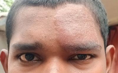 Amritesh Singh Thakur, Swiss Emmaus Leprosy Relief Work