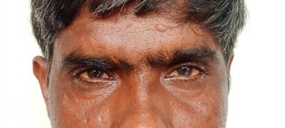 Amritesh Singh Thakur, Swiss Emmaus Leprosy Relief Work